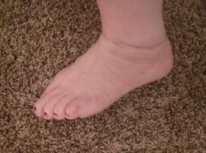 My poor swollen left ankle after walking around the state fair for four hours.